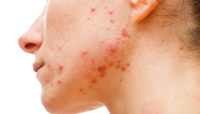 alimentos bons para a pele acne